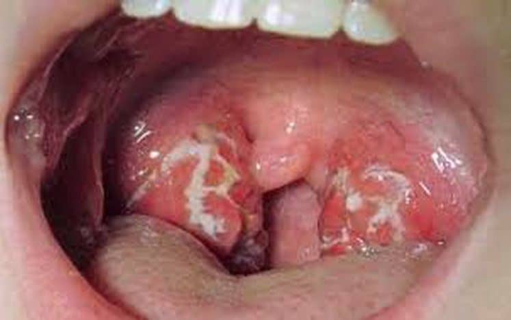 Detail Gambar Orang Yang Terkena Penyakit Difteri Nomer 3