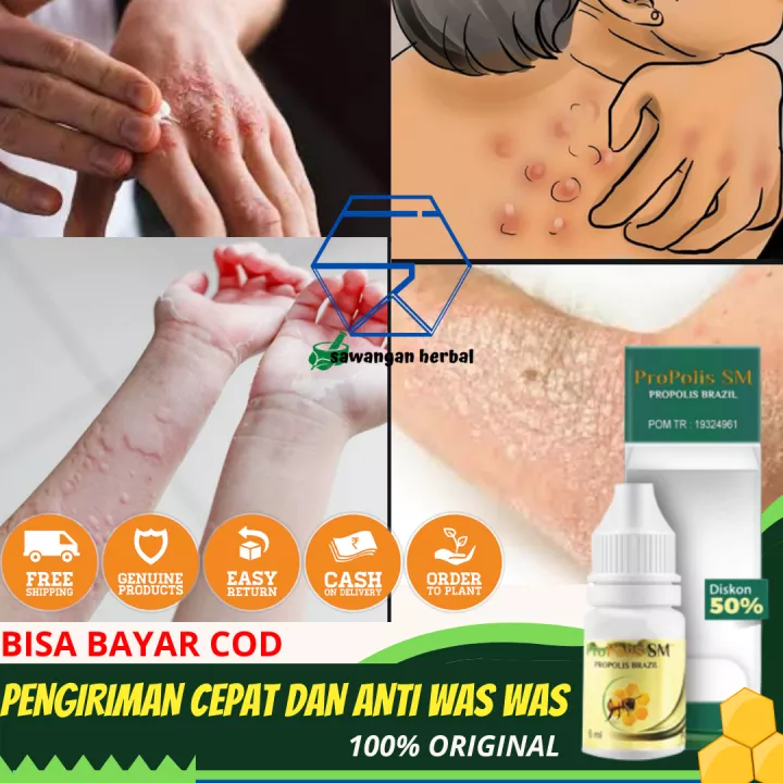 Detail Gambar Panu Kadas Kurap Kutu Air Nomer 28