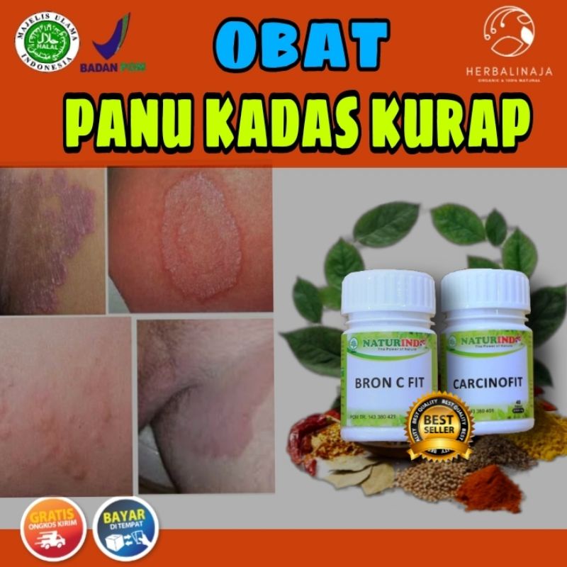 Detail Gambar Panu Kadas Kurap Kutu Air Nomer 49