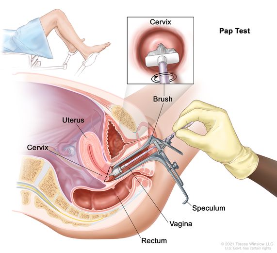 Gambar Pap Smear - KibrisPDR