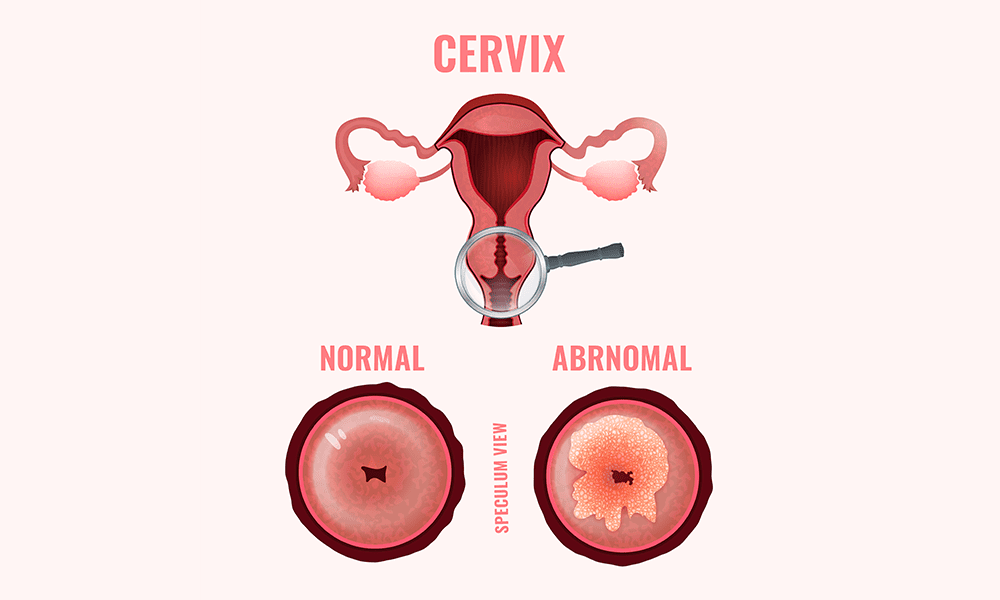 Detail Gambar Pap Smear Nomer 13