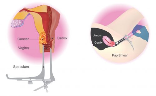 Detail Gambar Pap Smear Nomer 50