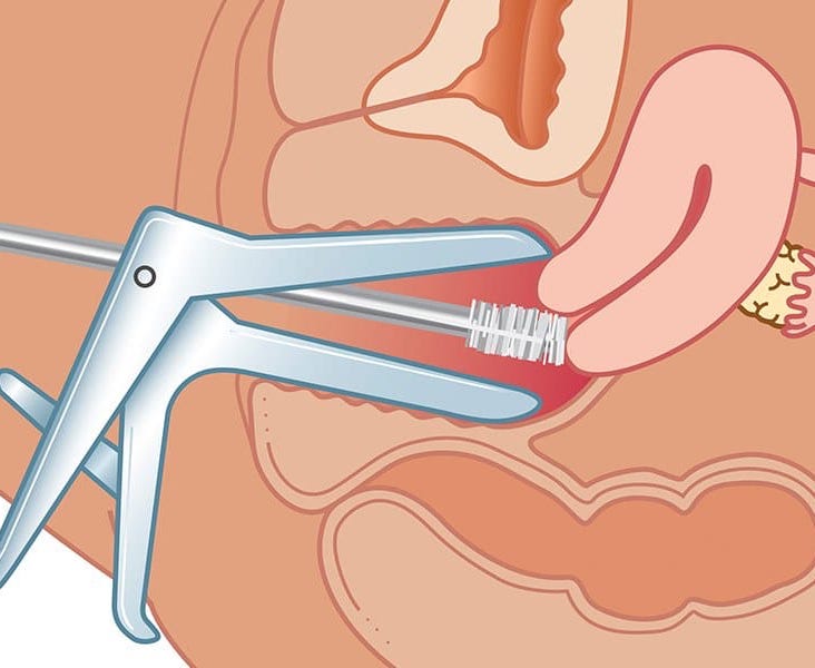Detail Gambar Pap Smear Nomer 7