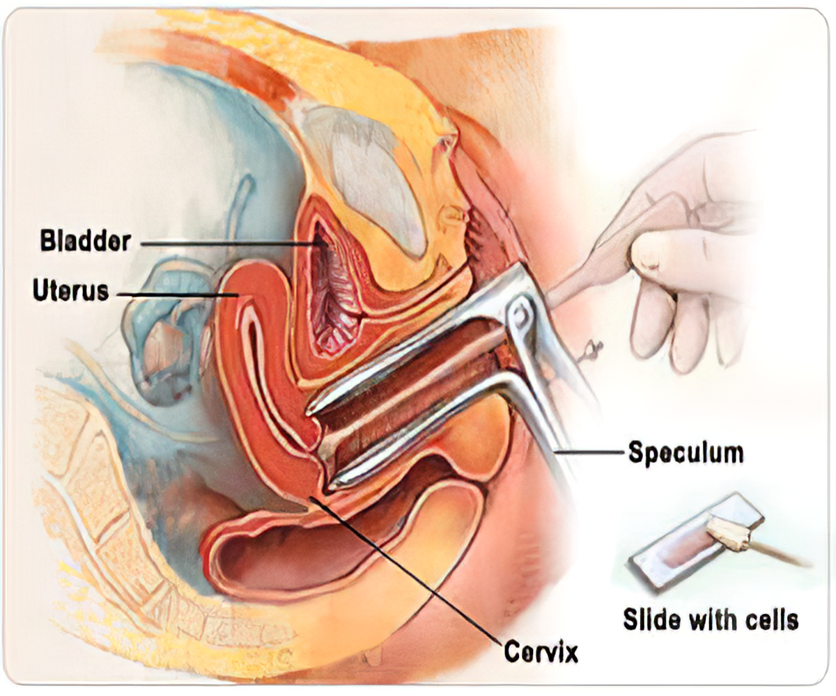 Detail Gambar Pap Smear Nomer 8