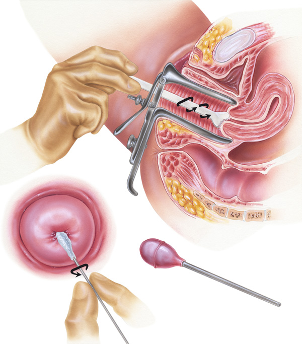 Detail Gambar Pap Smear Nomer 9