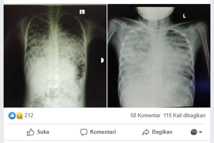 Detail Gambar Paru Paru Bronchopneumoni Pada Anak Nomer 22