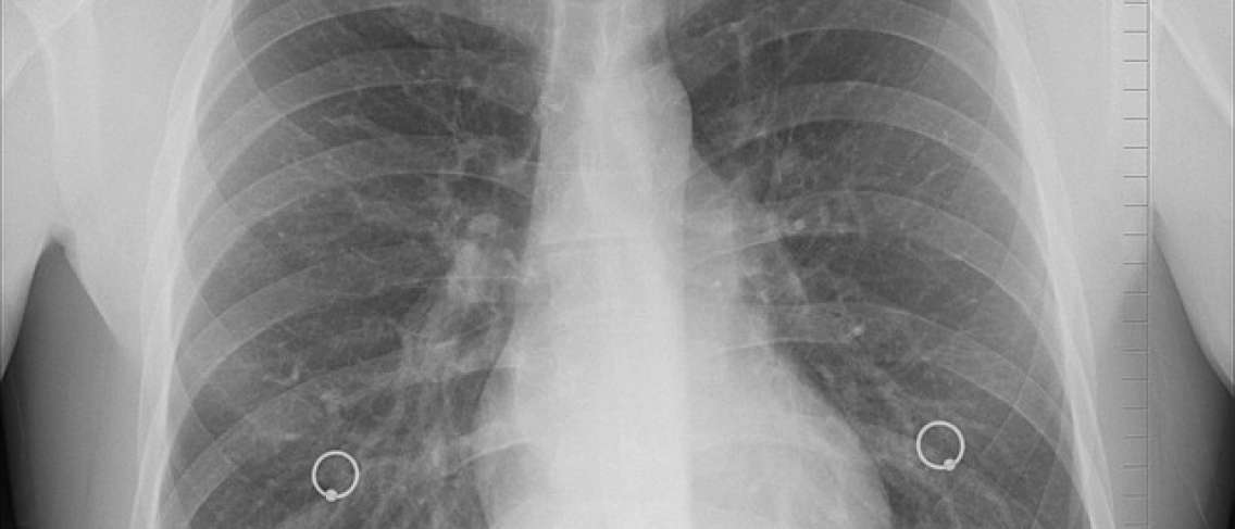 Detail Gambar Paru Paru Bronchopneumoni Pada Anak Nomer 51