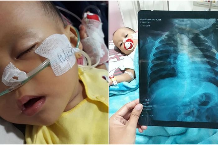 Detail Gambar Paru Paru Bronchopneumonia Pada Anak Nomer 18