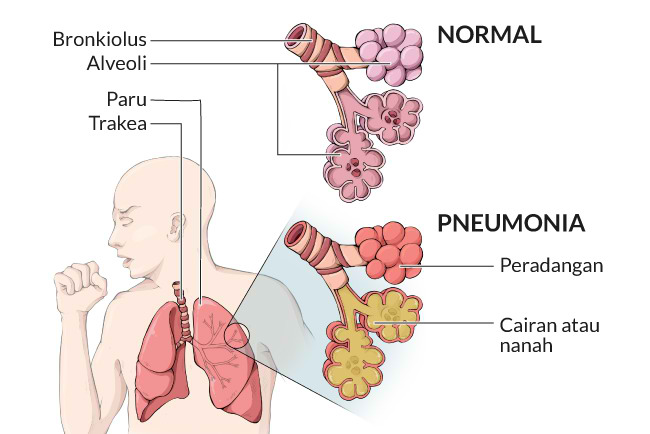 Detail Gambar Paru Paru Bronchopneumonia Pada Anak Nomer 19