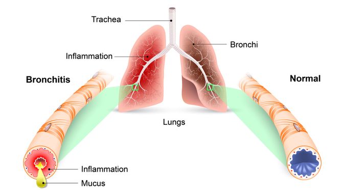 Detail Gambar Paru Paru Bronkitis Nomer 12