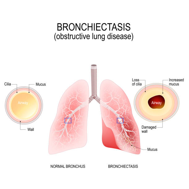 Detail Gambar Paru Paru Bronkitis Nomer 47