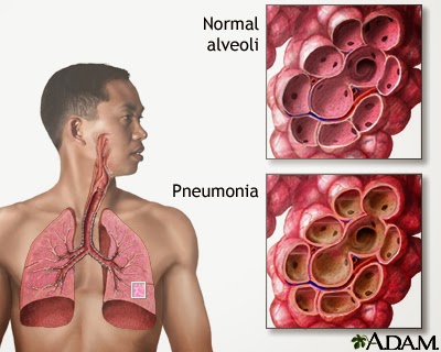 Detail Gambar Paru Paru Dengan Bronchopneumini Pada Anak Nomer 44