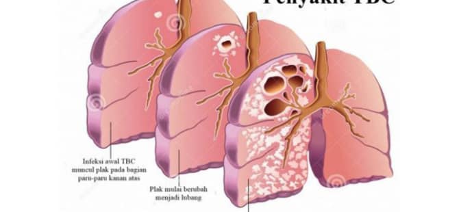 Detail Gambar Paru Paru Tbc Nomer 26