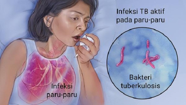 Detail Gambar Paru Paru Tbc Nomer 30