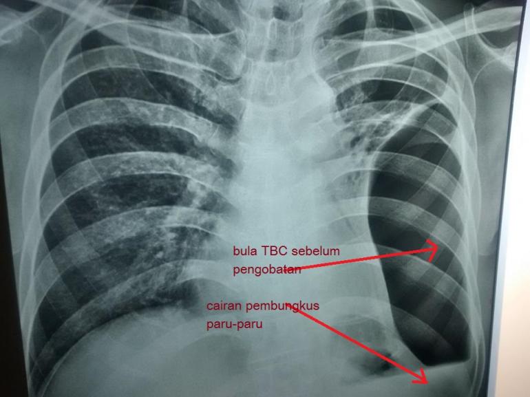 Detail Gambar Paru Paru Tbc Nomer 41