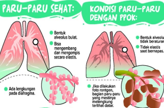 Detail Gambar Paru Paru Yang Terkena Asma Nomer 44