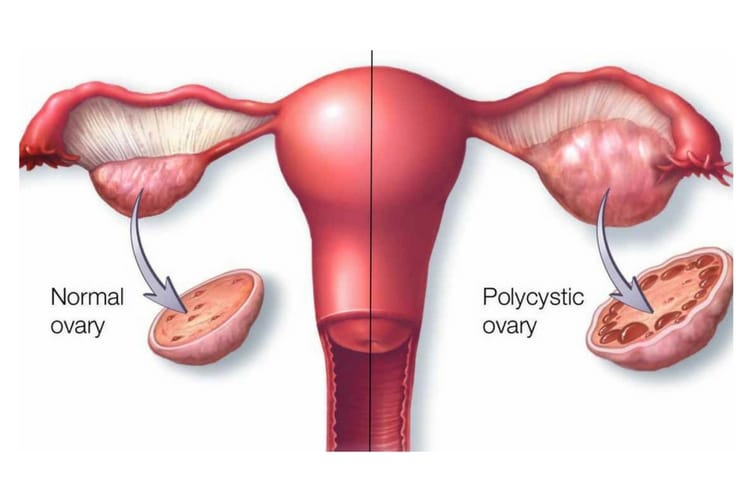 Detail Gambar Patofisiologi Menstruasi Nomer 14
