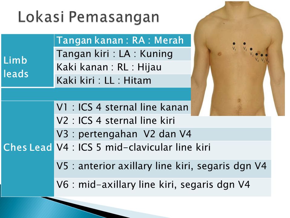 Detail Gambar Pemasangan Ekg Nomer 12