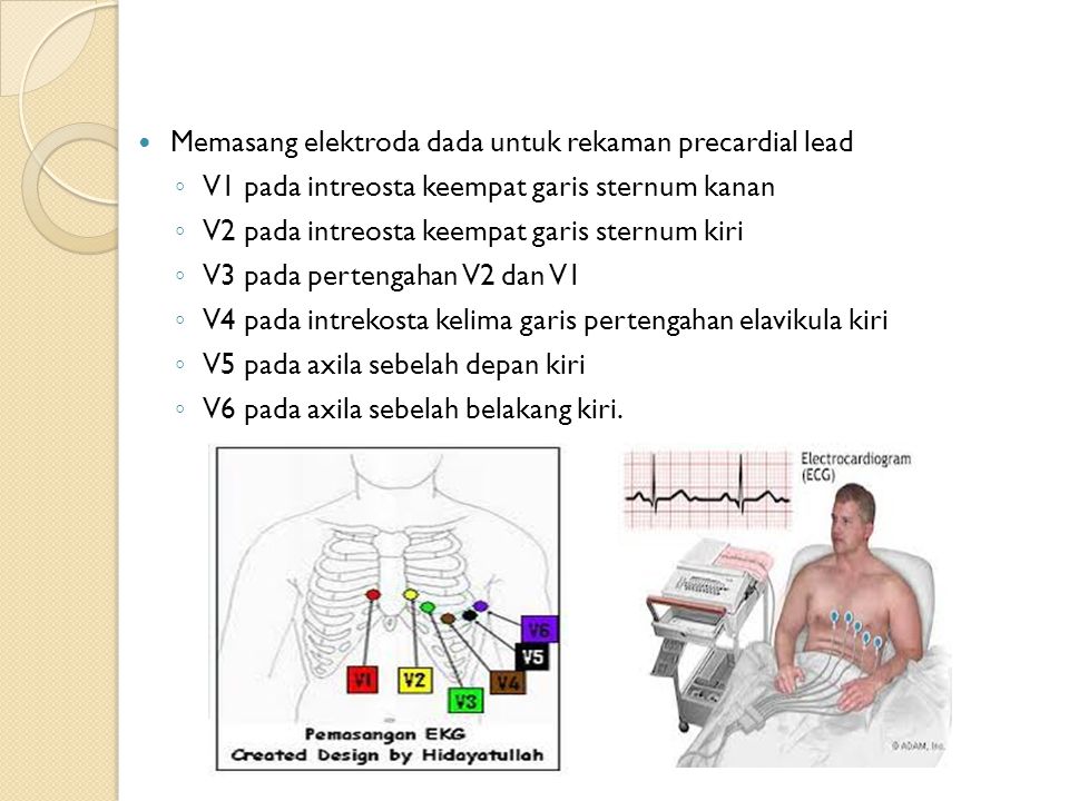 Detail Gambar Pemasangan Ekg Nomer 21