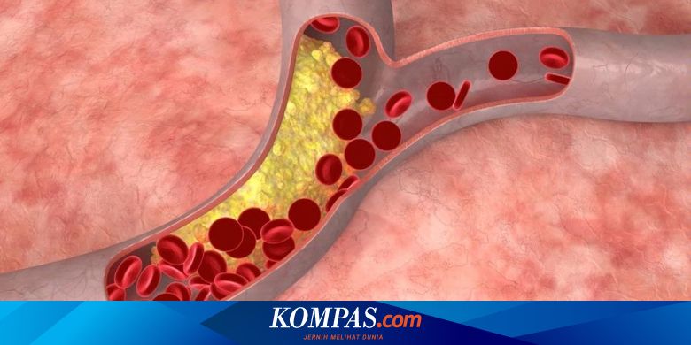 Gambar Pembuluh Darah Pecah - KibrisPDR