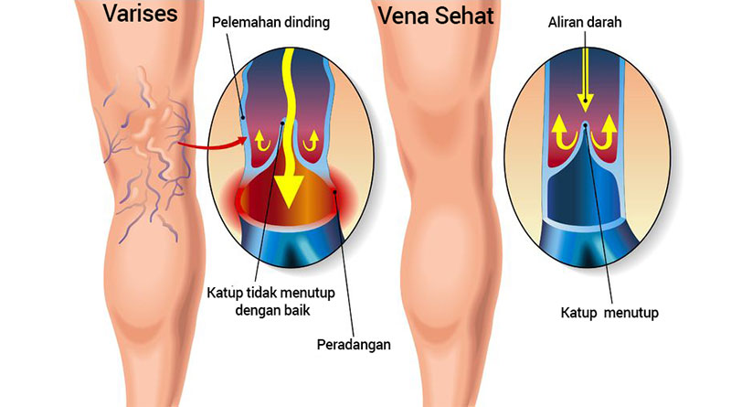 Detail Gambar Pembuluh Vena Nomer 20