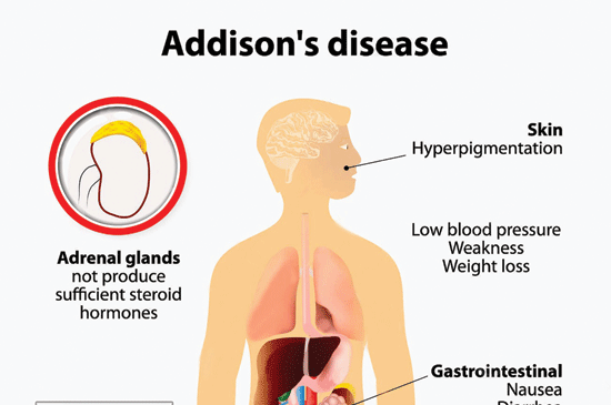 Detail Gambar Penyakit Addison Nomer 10