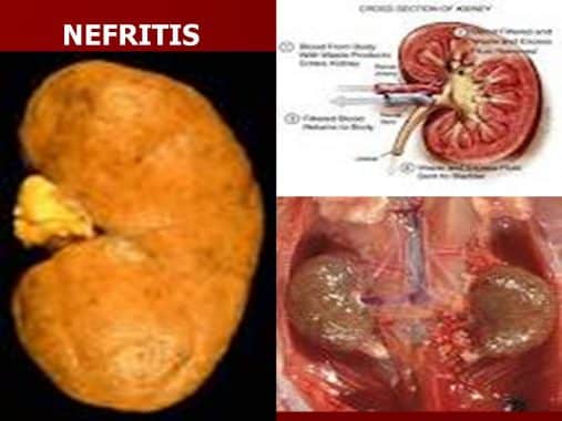 Detail Gambar Penyakit Albuminuria Nomer 44