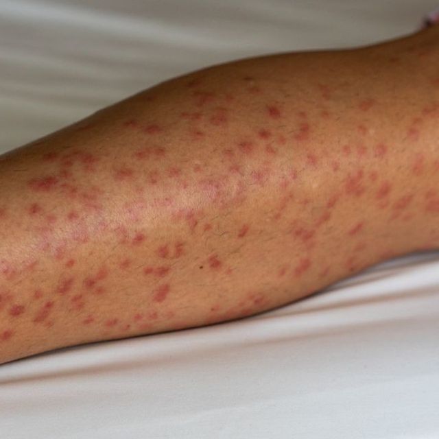 Detail Gambar Penyakit Alergi Nomer 37