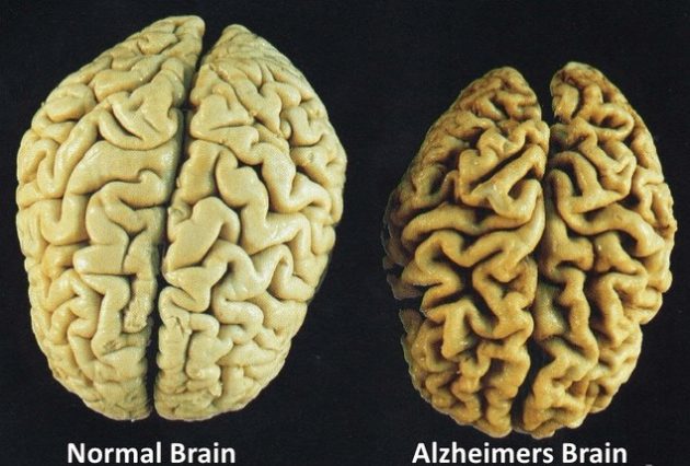 Detail Gambar Penyakit Alzheimer Nomer 10