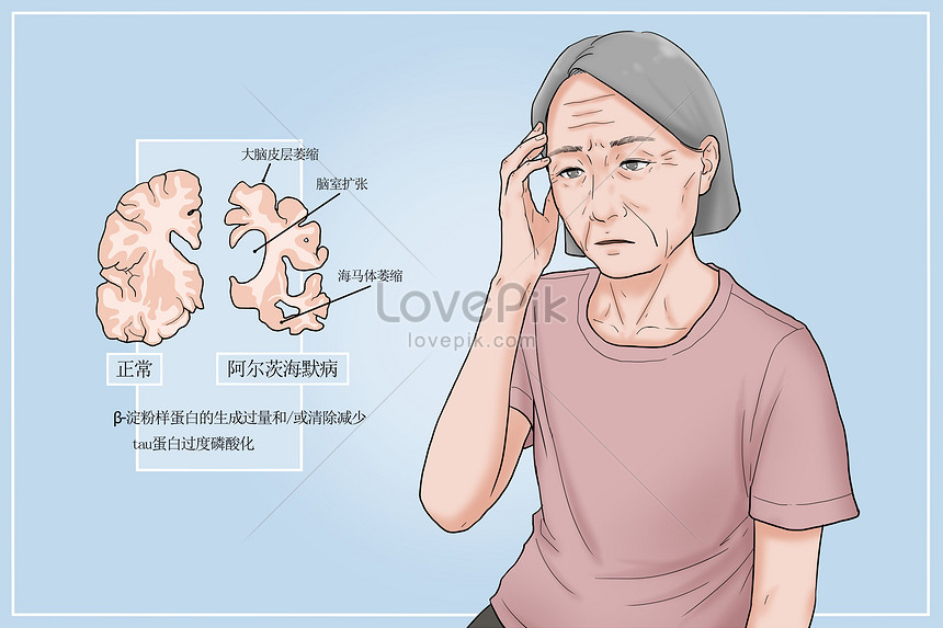 Detail Gambar Penyakit Alzheimer Nomer 11