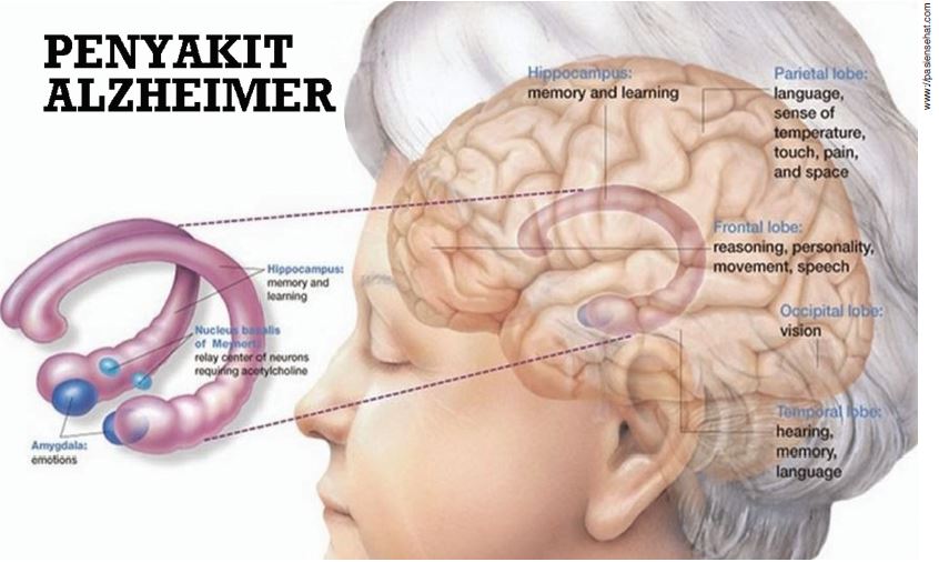 Detail Gambar Penyakit Alzheimer Nomer 5