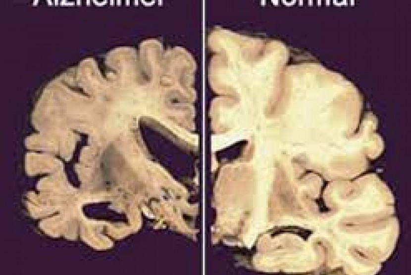 Detail Gambar Penyakit Alzheimer Nomer 6