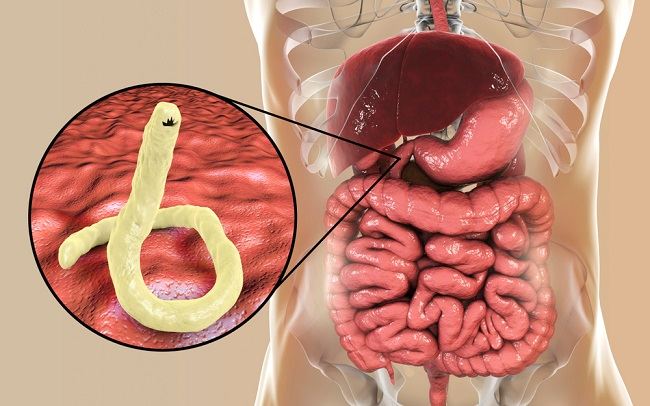 Gambar Penyakit Anchilostomiasis - KibrisPDR