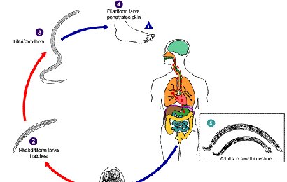 Detail Gambar Penyakit Anchilostomiasis Nomer 4