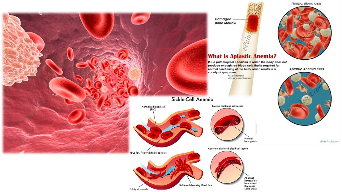 Detail Gambar Penyakit Anemia Nomer 14