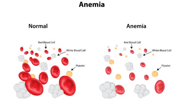 Detail Gambar Penyakit Anemia Nomer 17