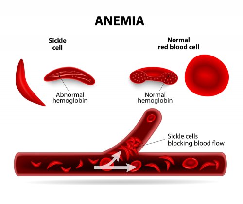 Detail Gambar Penyakit Anemia Nomer 3