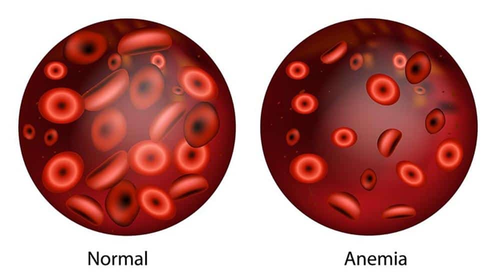 Detail Gambar Penyakit Anemia Nomer 5