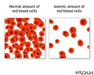 Detail Gambar Penyakit Anemia Nomer 37