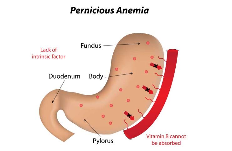 Detail Gambar Penyakit Anemia Nomer 46