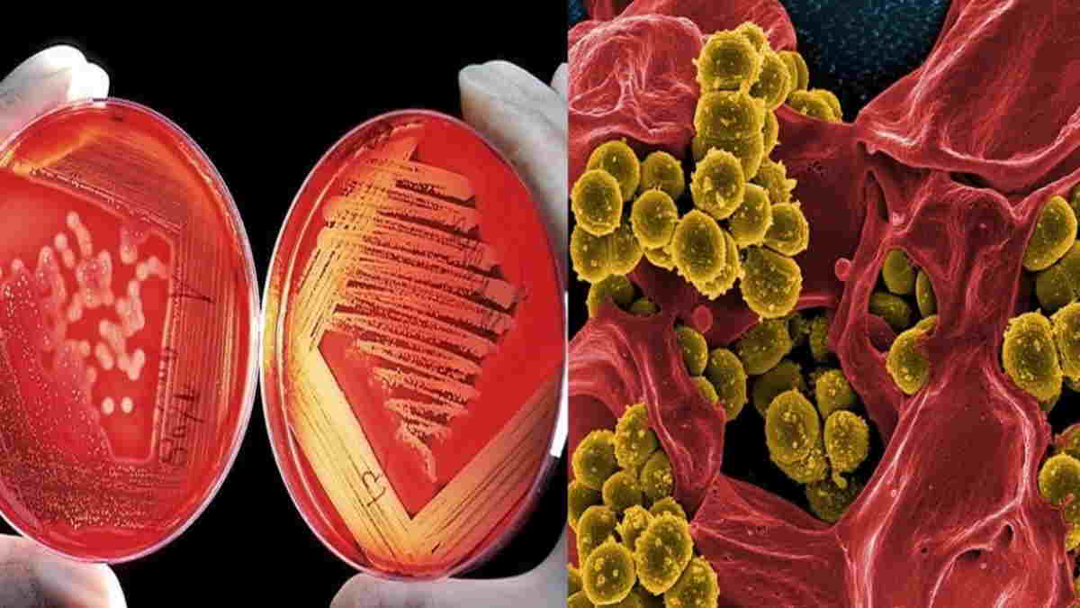 Detail Gambar Penyakit Anemia Nomer 7