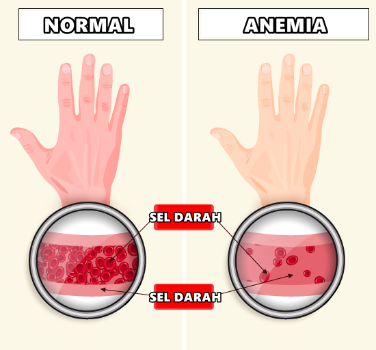 Detail Gambar Penyakit Anemia Nomer 10