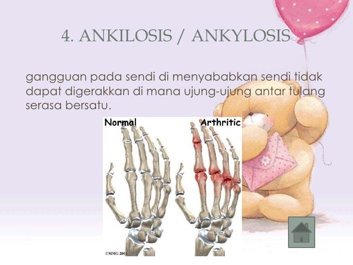 Detail Gambar Penyakit Ankilosis Nomer 8