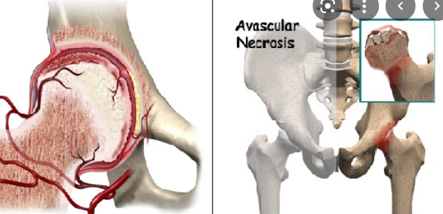 Detail Gambar Penyakit Ankilosis Nomer 22