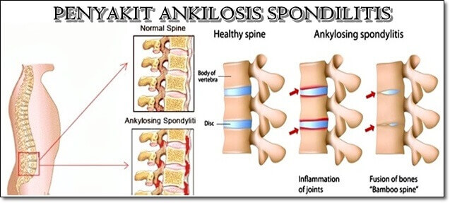 Detail Gambar Penyakit Ankilosis Nomer 5