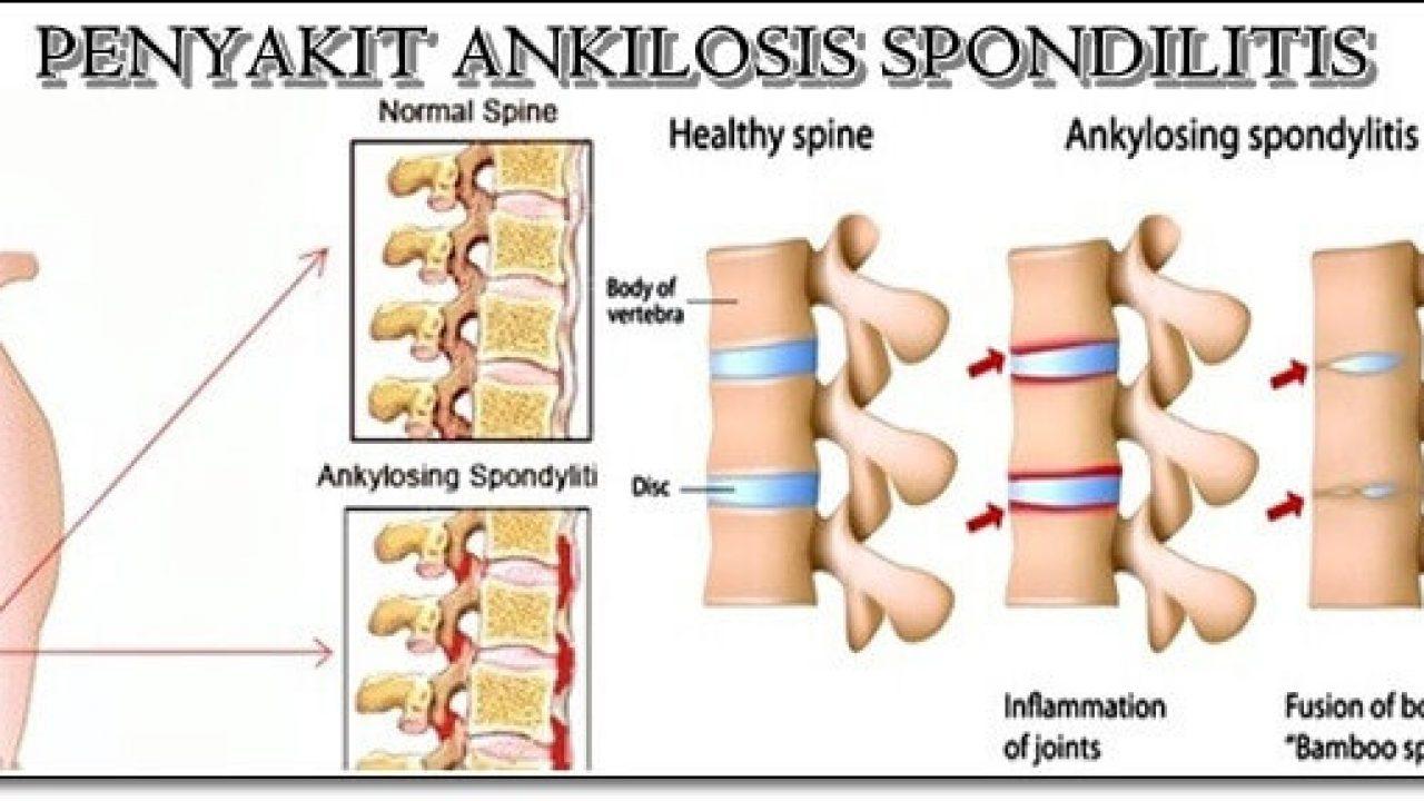 Detail Gambar Penyakit Ankilosis Nomer 6