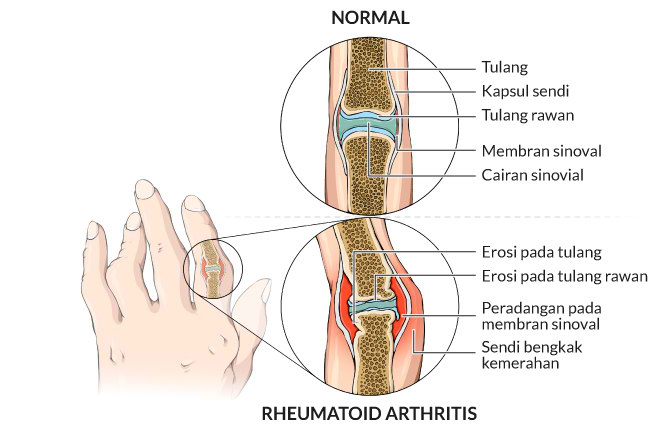 Detail Gambar Penyakit Artritis Nomer 2