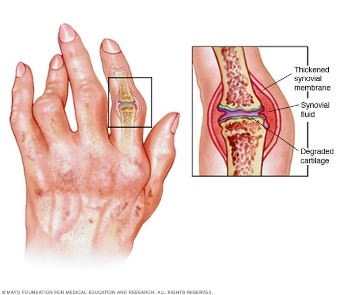 Detail Gambar Penyakit Artritis Nomer 19