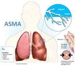 Detail Gambar Penyakit Asma Nomer 38