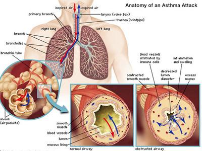 Detail Gambar Penyakit Asma Nomer 5